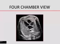 Feta Echocardiography – Four Chamber View