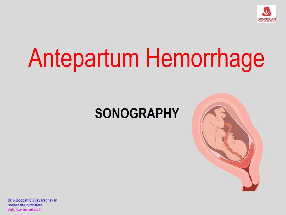 Antepartum Hemorrhage - Sonography