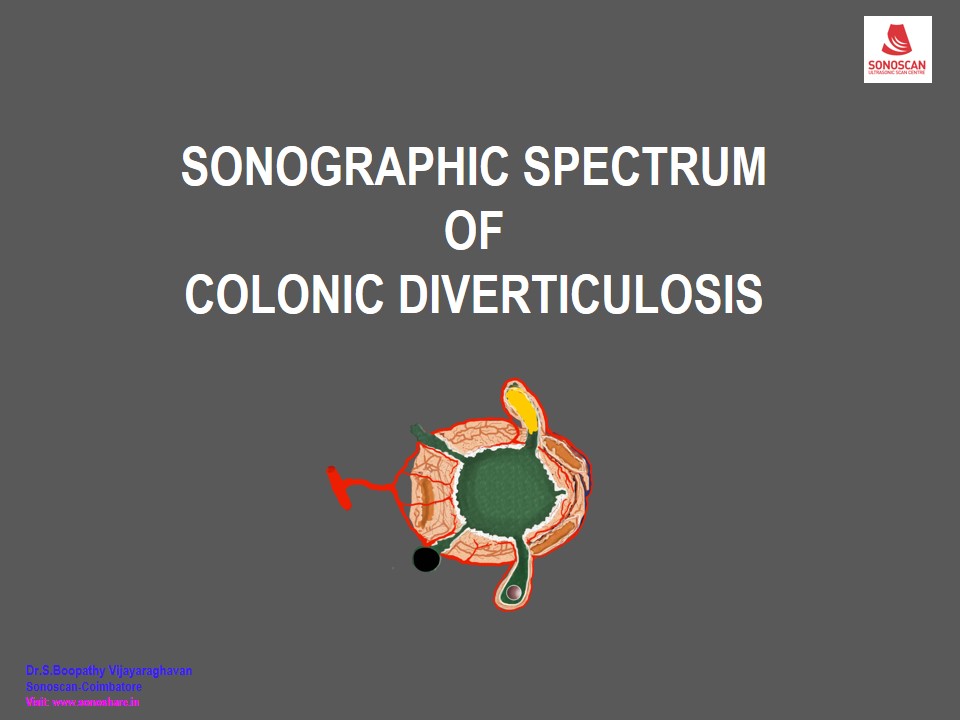 Sonography of Diverticulosis of Colon_2020
