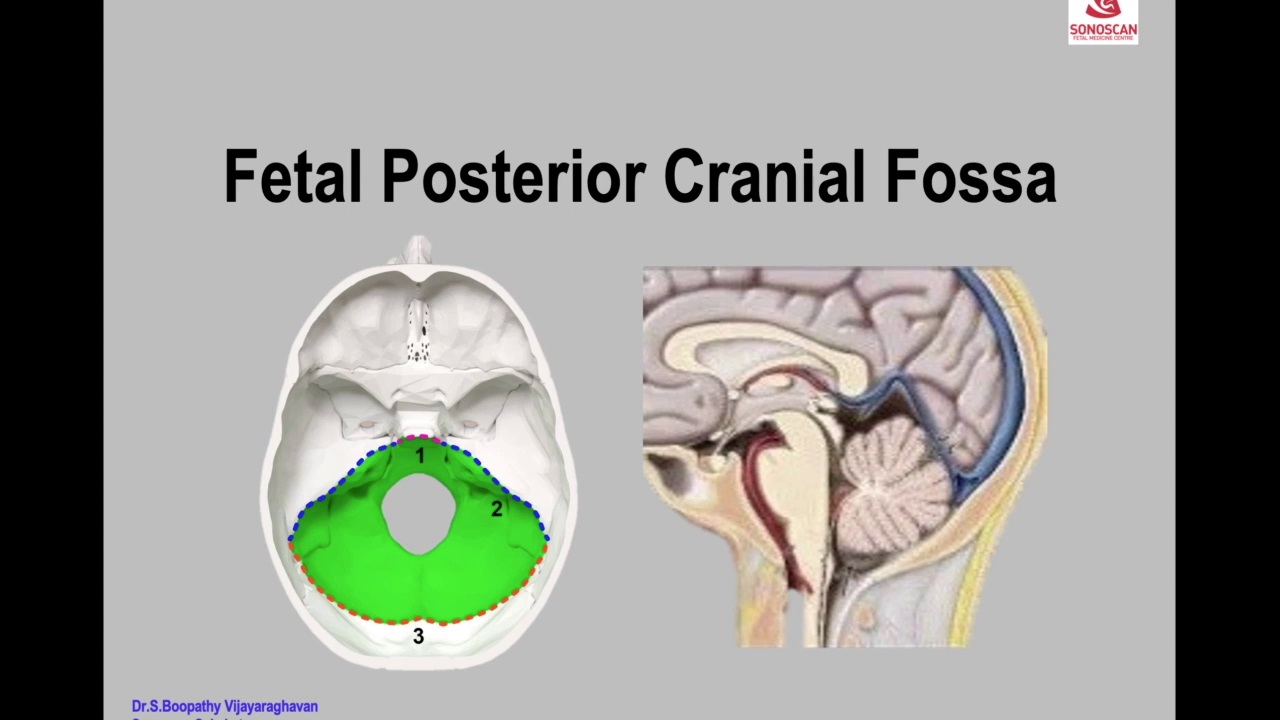 Fetal posterior cranial fossa anomalies