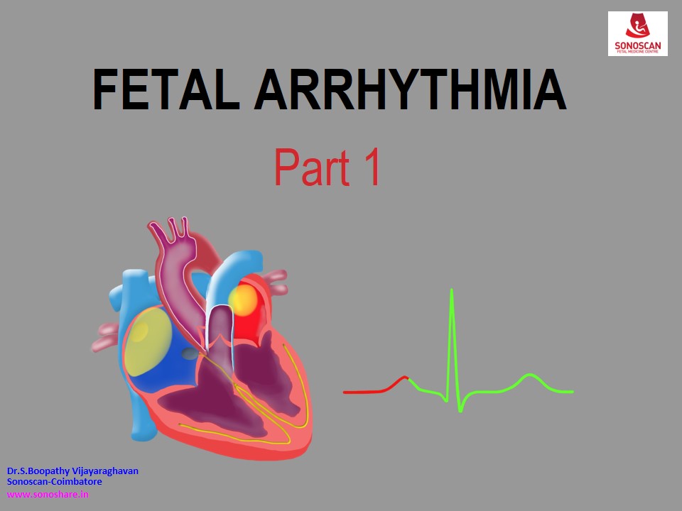 Feta Echocardiography – Fetal_Arrhythmia_2021_PART_1