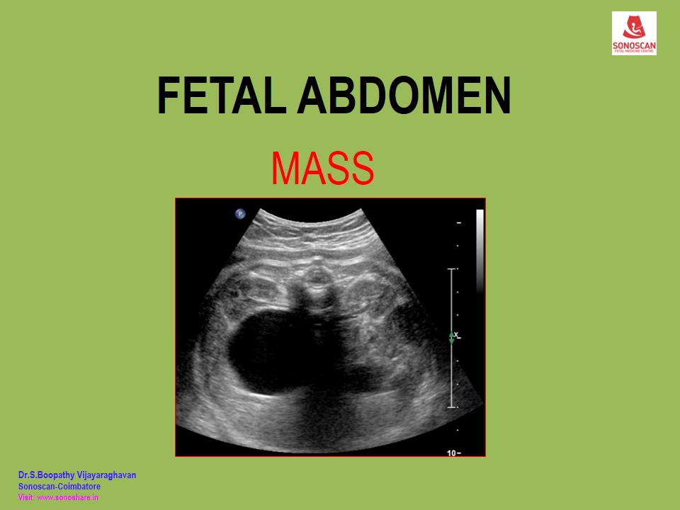 Fetal Abdominal Mass