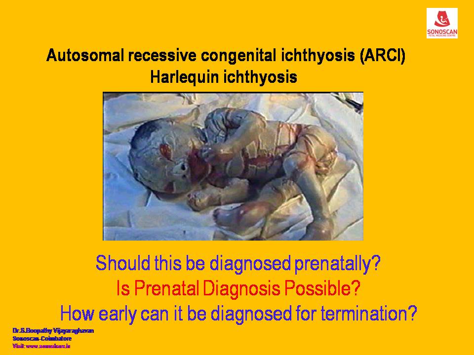 Congenital (Harlequin) Icthyosis: Prenatal Diagnosis