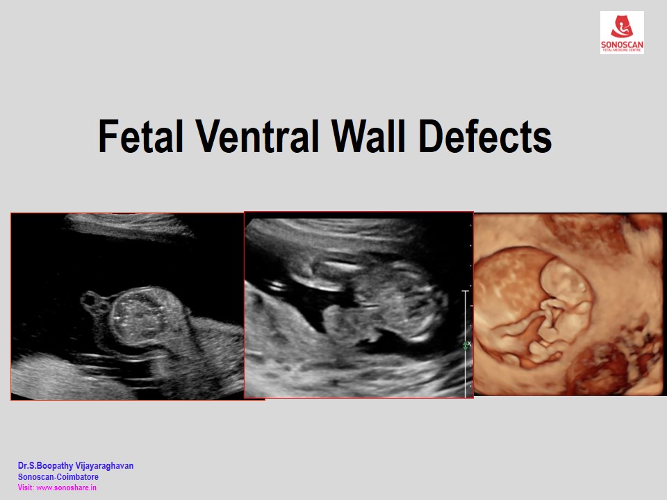 Fetal Ventral Wall Defects
