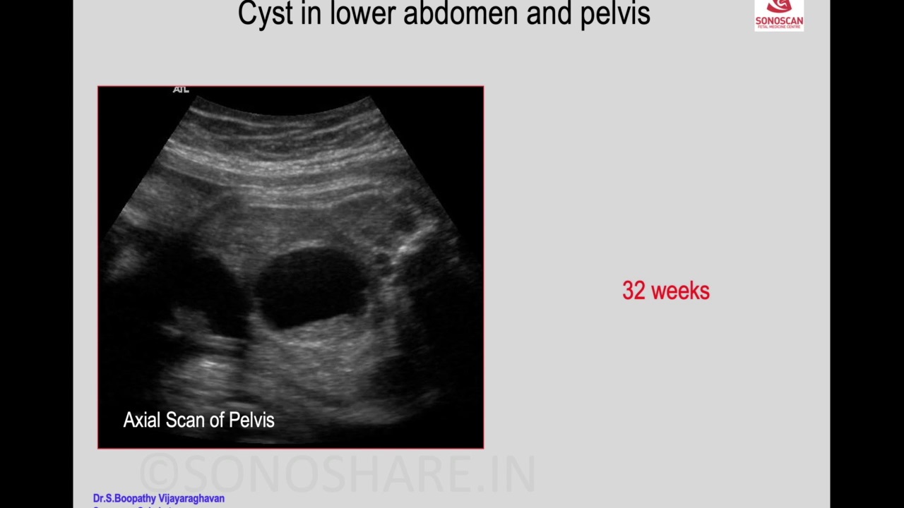Image to Diagnosis – Fetal Medicine – Cyst in fetal pelvis 1