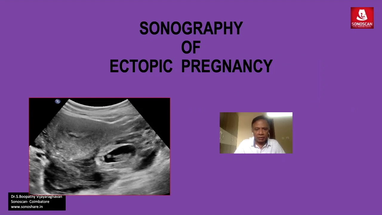 Sonography of Ectopic Gestation