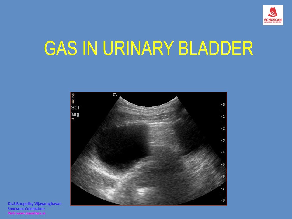 Sonography of Gas in Urinary Bladder