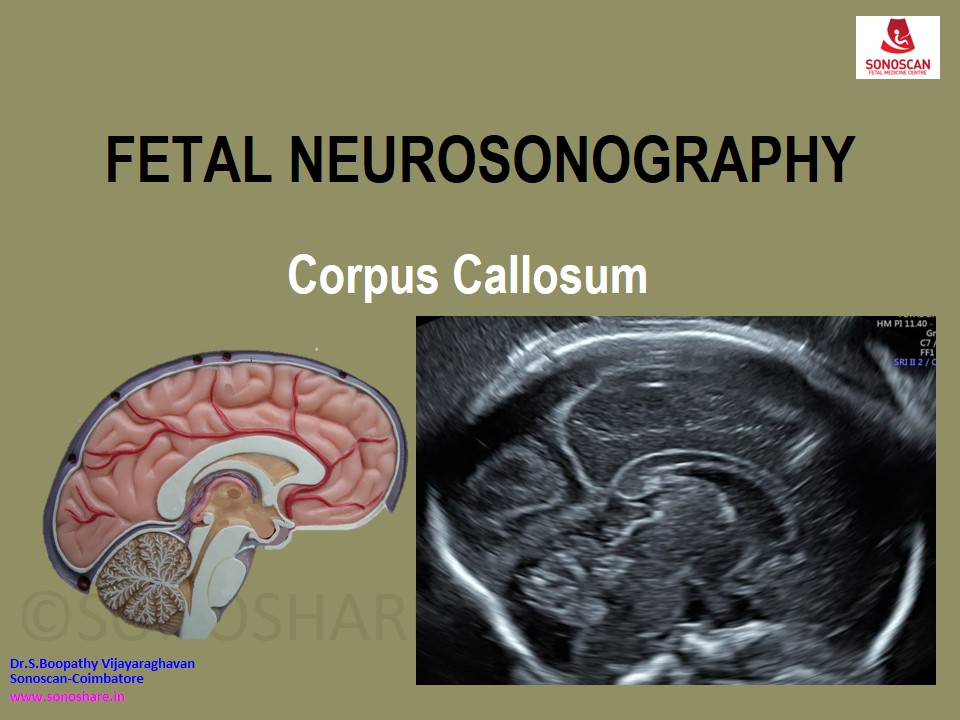 Fetal Neurosonography – Corpus Callosum