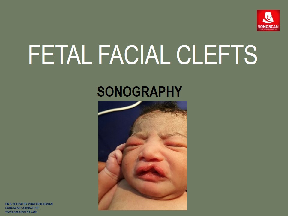 Fetal Facial Clefts - Sonography