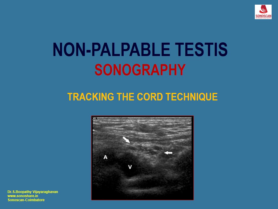 Sonography of Non-Palpable Testis