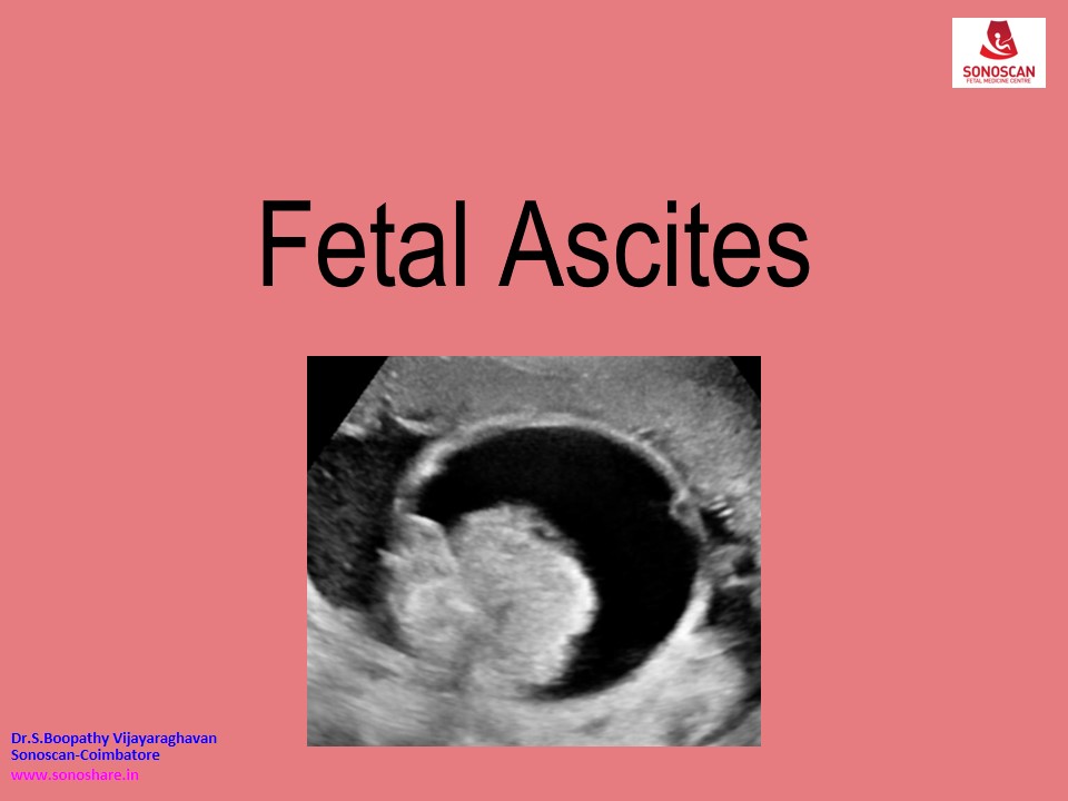 Sonography of Fetal Ascites