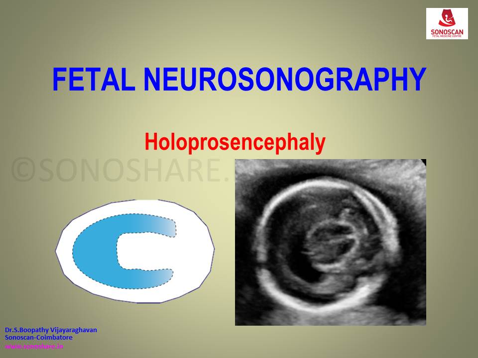 Fetal Neurosonography – Holoprosencephaly