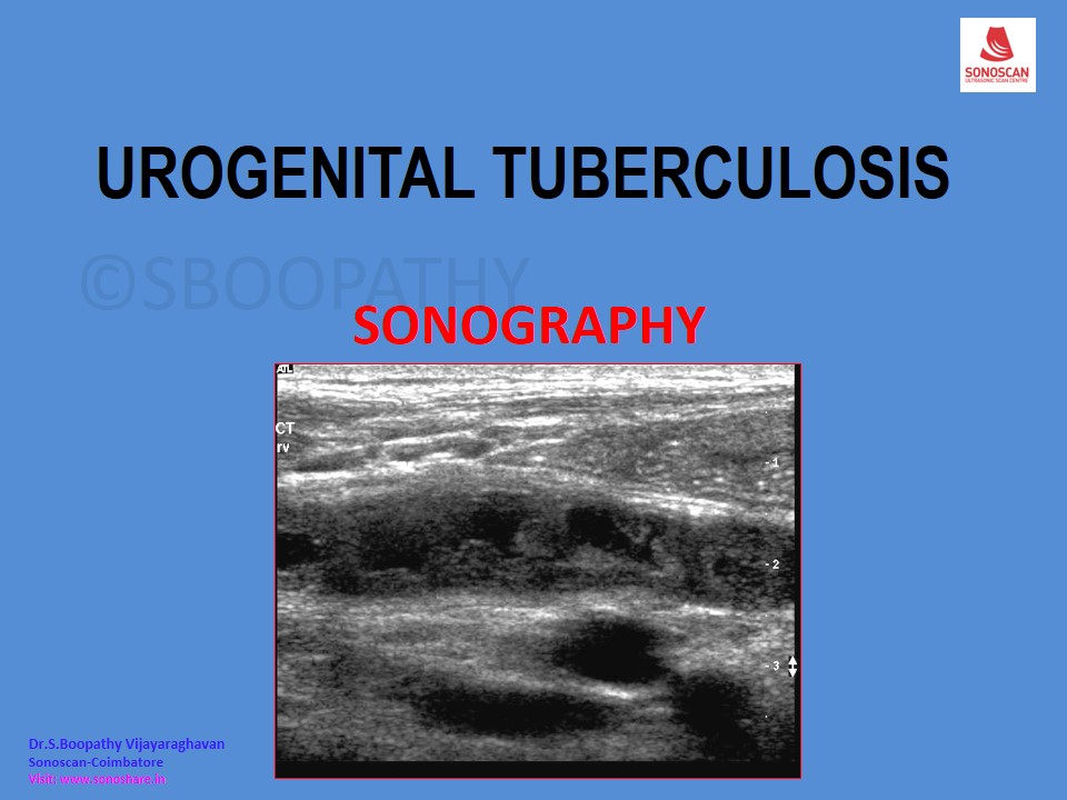 Sonography of Urogenital Tuberculosis