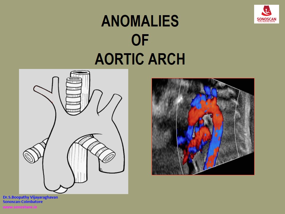 Feta Echocardiography – Anomalies of Aortic Arch_2021