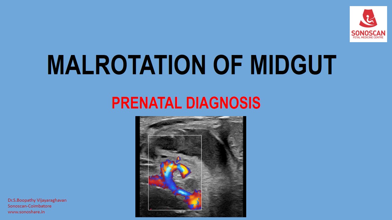 Prenatal Diagnosis of Malrotation of Midgut