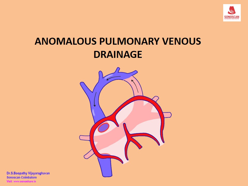 Feta Echocardiography – Anomalous Pulmonary Venous Connection