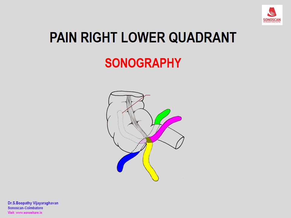 Sonography of Pain in Right Iliac Fossa_2020