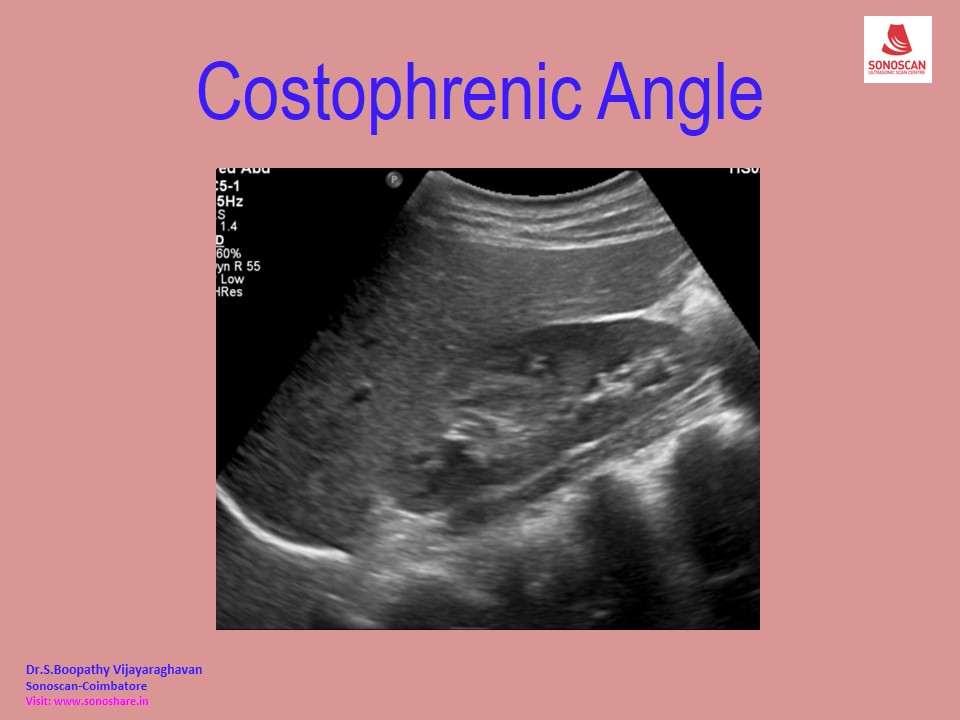Sonography of Costophrenic Angle