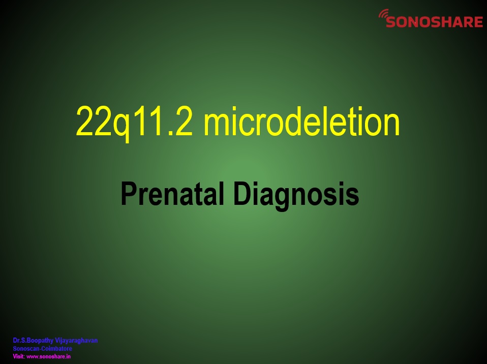 Prenatal Diagnosis_22q11microdeletion